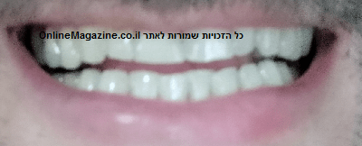 הסרת כתמים בשיניים בדרך טבעית תמונה אחרי צחצוח